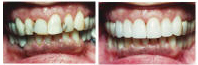 anterior-crown