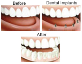 implant-dentures implant-dentures