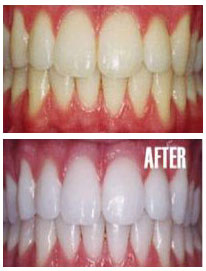 teeth-whitening