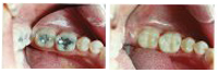 tooth-colored-fillings