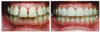 veneers_small