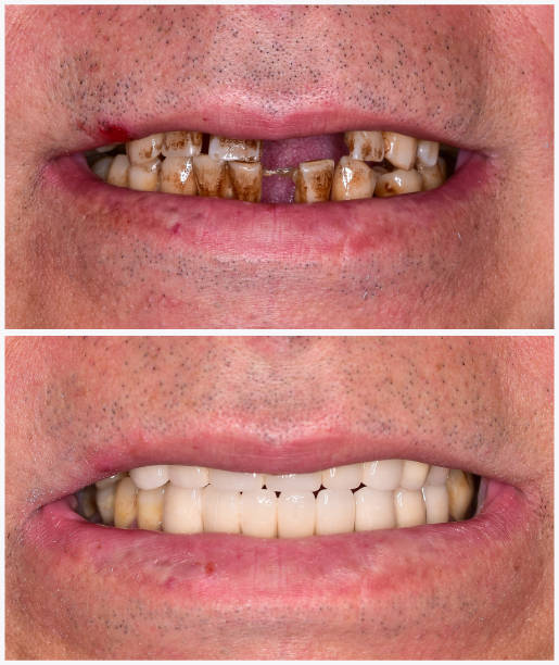 implant treatment before and after picture